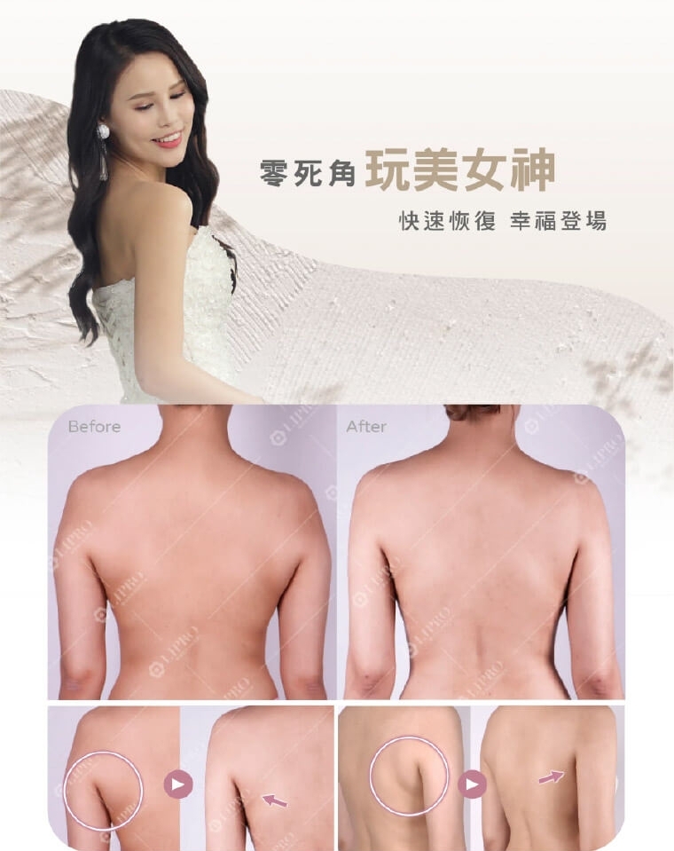 副乳手術_副乳抽脂_顯微套管抽脂_副乳消除