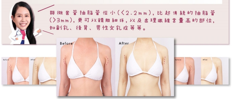 副乳手術_副乳抽脂_顯微套管抽脂_副乳消除