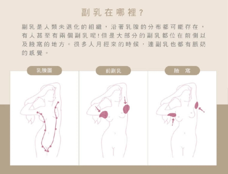 副乳手術_副乳抽脂_顯微套管抽脂副乳_副乳消除