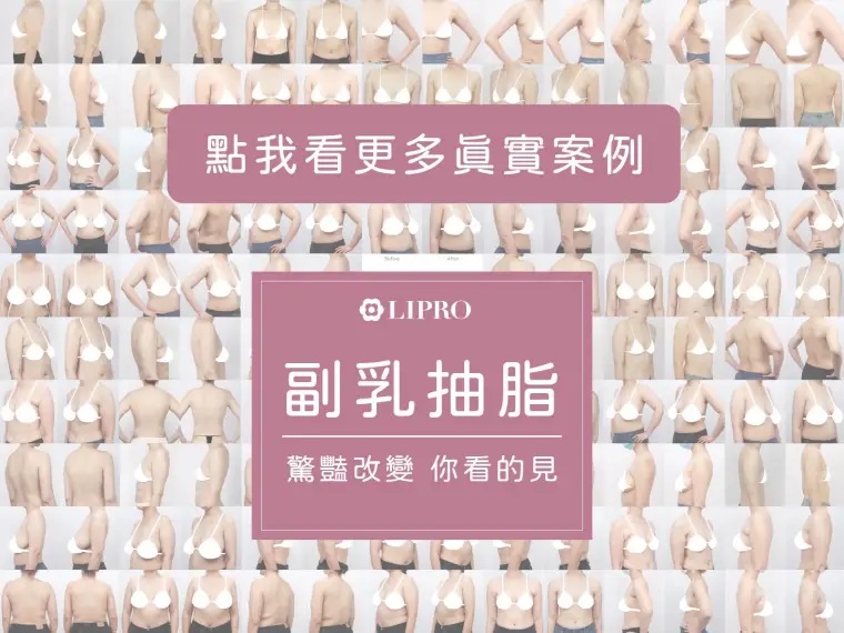 副乳手術_副乳抽脂_顯微套管抽脂_副乳消除