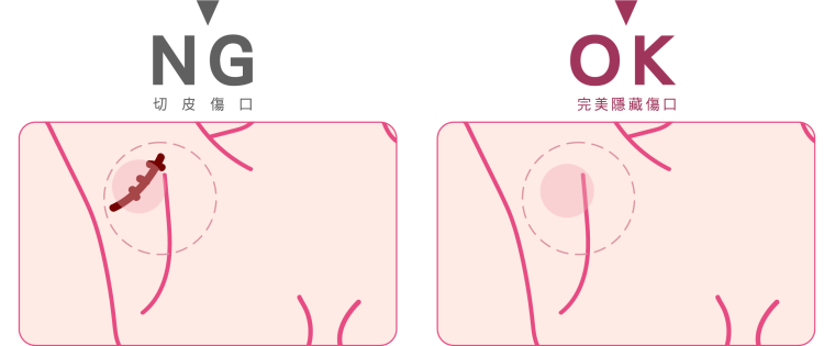 副乳手術_副乳抽脂_顯微套管抽脂_副乳消除