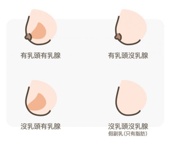 副乳手術_副乳抽脂_顯微套管抽脂_副乳消除