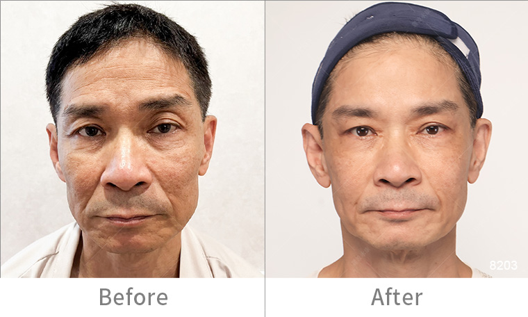 墨菲斯電波術後效果