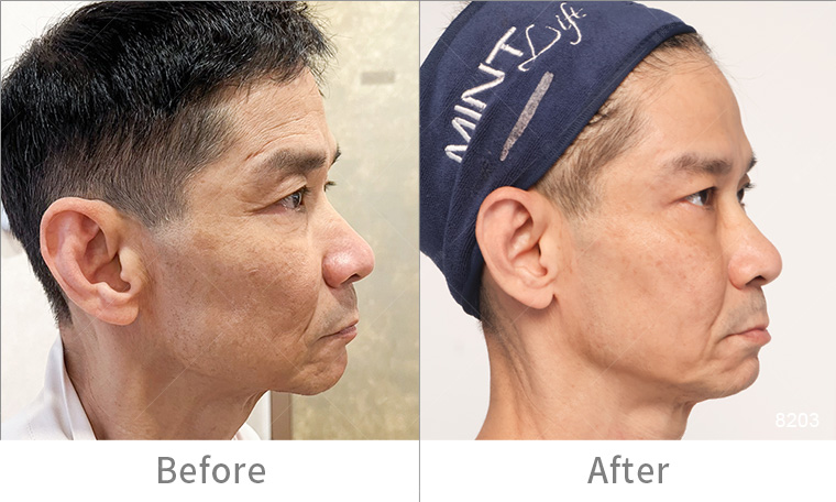 墨菲斯電波術後效果