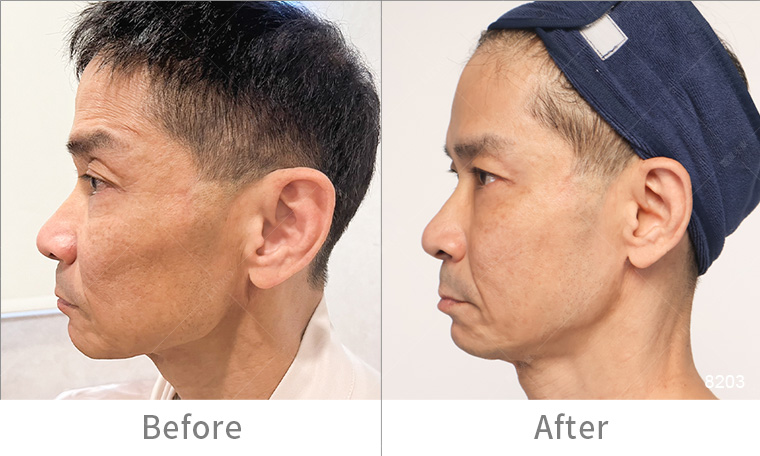 墨菲斯電波術後效果