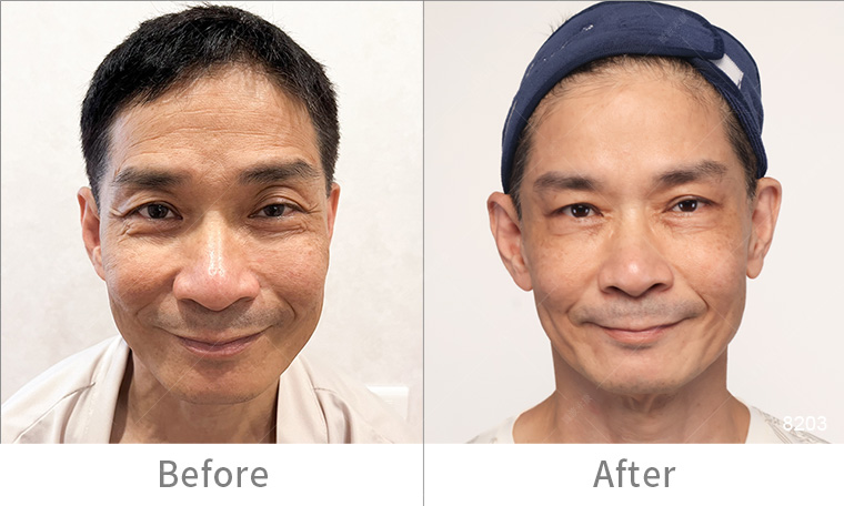 墨菲斯電波術後效果