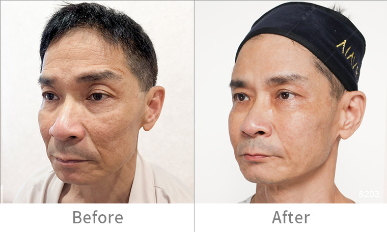 墨菲斯電波術後效果