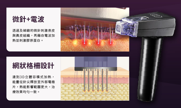 墨菲斯電波修復期,墨菲斯電波術後,麗波永康國際診所