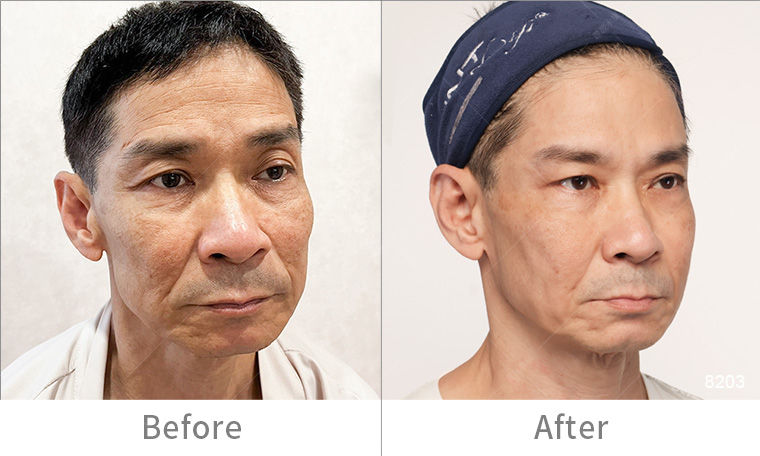 墨菲斯電波術後效果