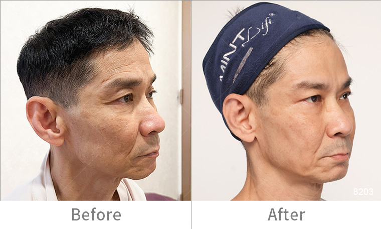 墨菲斯電波術後效果