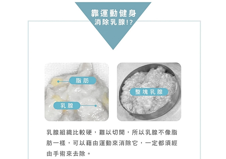 男性女乳健身有用嗎_男性女乳運動_男性女乳症改善案例_女乳症手術