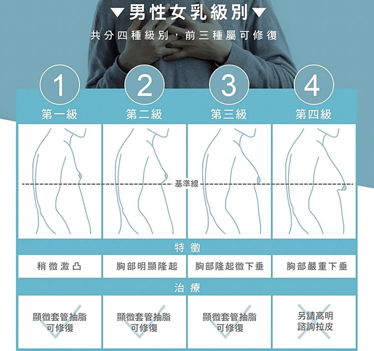 男性女乳症費用,男性女乳健保,女乳症費用,男性女乳保險理賠