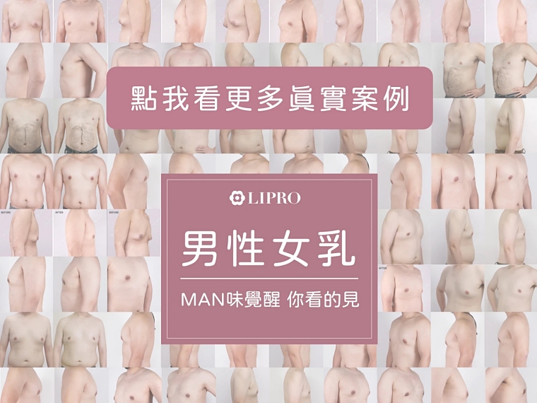 男性女乳症費用,男性女乳健保,女乳症費用,男性女乳保險理賠