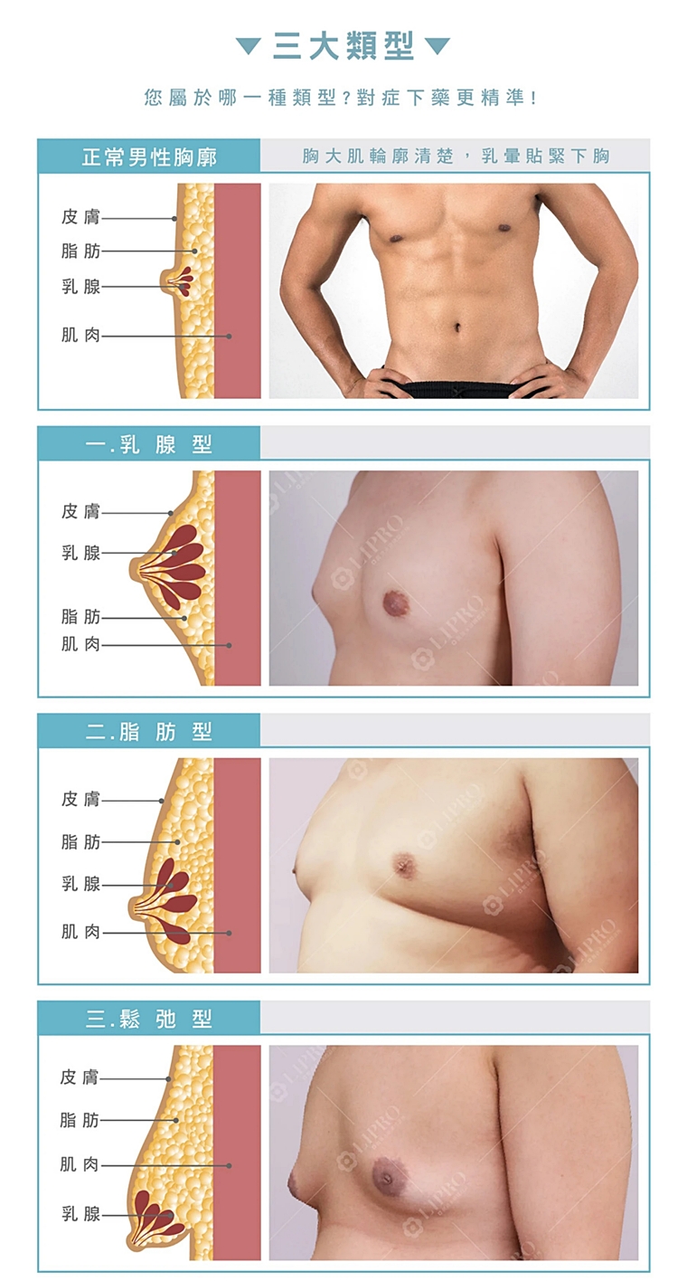 男性女乳症費用,男性女乳健保,女乳症費用,男性女乳保險理賠