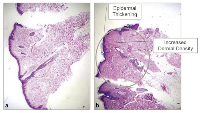 EmbraceRF是什麼,鈦特離子夾,FaceTite,BodyTite,Accutite
