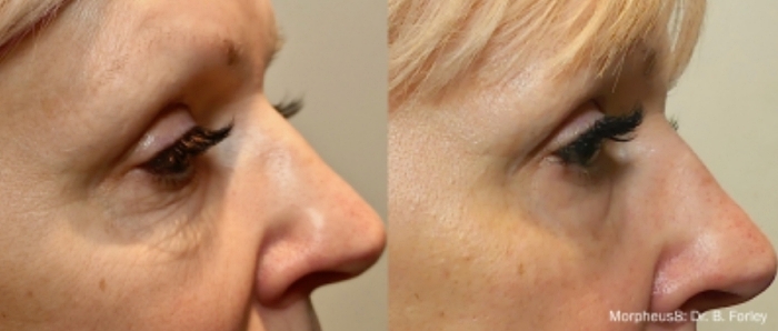 EmbraceRF是什麼,鈦特離子夾,FaceTite,BodyTite,Accutite