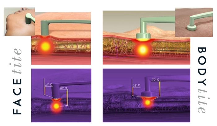 EmbraceRF是什麼,鈦特離子夾,FaceTite,BodyTite,Accutite