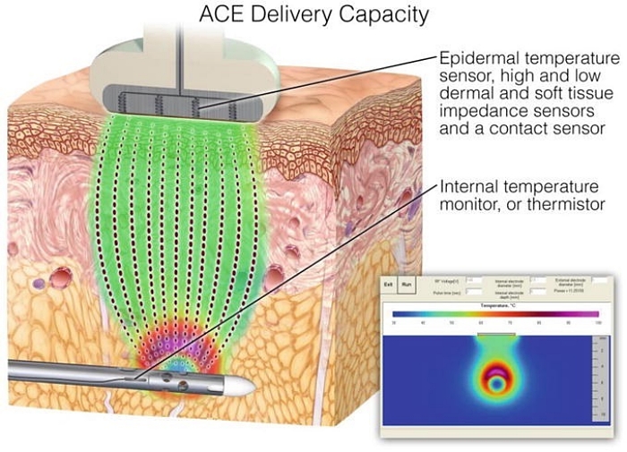 EmbraceRF是什麼,鈦特離子夾,FaceTite,BodyTite,Accutite