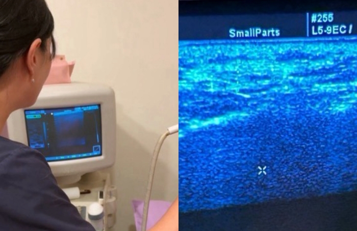 饅化臉修復,玻尿酸饅化,醫美饅化,饅化有救嗎