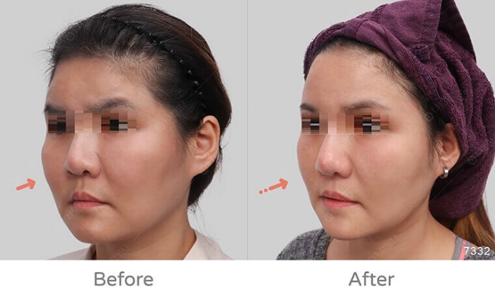 饅化臉修復,玻尿酸饅化,醫美饅化,饅化有救嗎