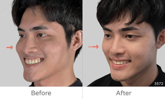 饅化臉修復,玻尿酸饅化,醫美饅化,饅化有救嗎