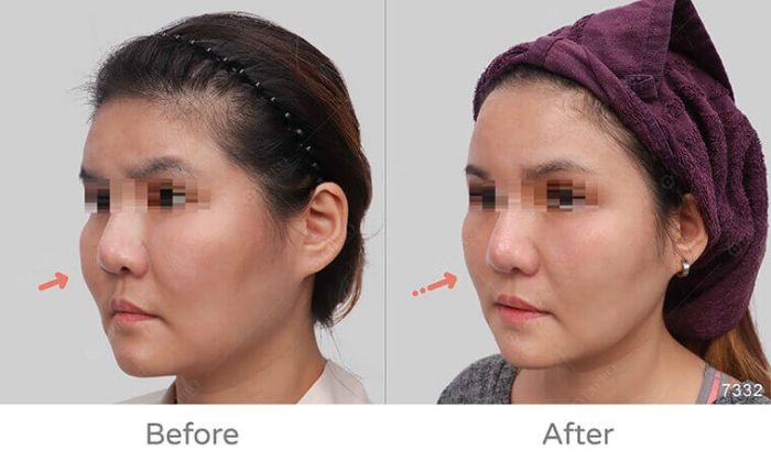 饅化臉修復,玻尿酸饅化,醫美饅化,饅化有救嗎