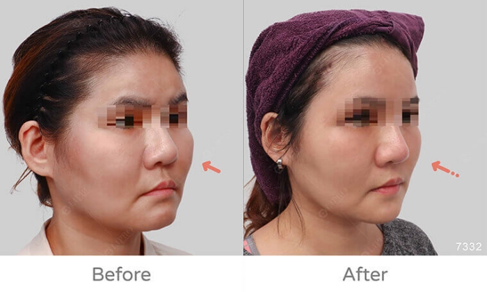 饅化臉修復,玻尿酸饅化,醫美饅化,饅化有救嗎