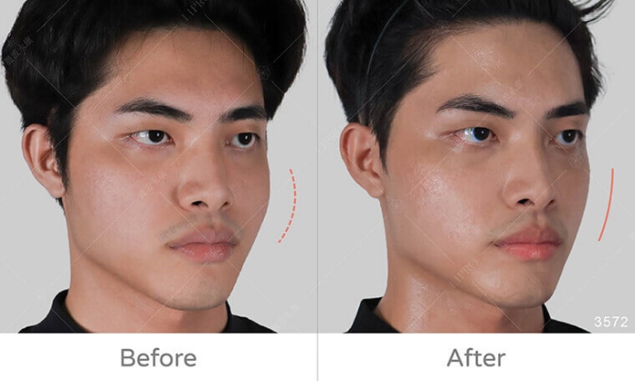 饅化臉修復,玻尿酸饅化,醫美饅化,饅化有救嗎