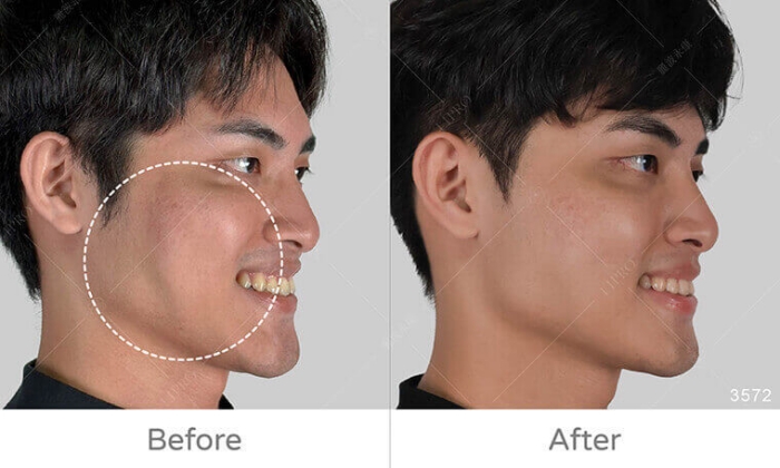 饅化臉修復,玻尿酸饅化,醫美饅化,饅化有救嗎