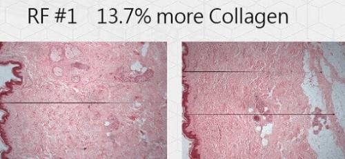 InMode鑽石超塑,InMode台灣叫什麼,InMode是什麼,InMode台灣價格,InMode