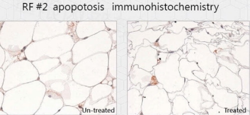 InMode鑽石超塑,InMode台灣叫什麼,InMode是什麼,InMode台灣價格,InMode