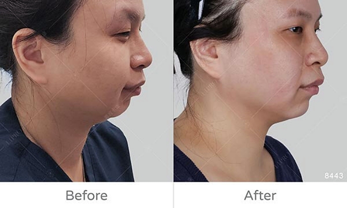 InMode鑽石超塑,InMode台灣叫什麼,InMode是什麼,InMode台灣價格,InMode