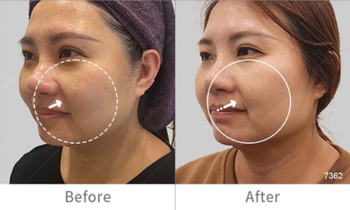 InMode鑽石超塑,InMode台灣叫什麼,InMode是什麼,InMode台灣價格,InMode