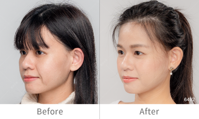 InMode鑽石超塑,InMode台灣叫什麼,InMode是什麼,InMode台灣價格,InMode