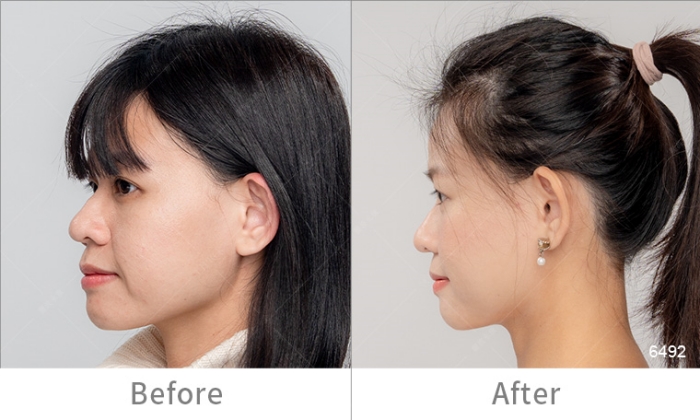 InMode鑽石超塑,InMode台灣叫什麼,InMode是什麼,InMode台灣價格,InMode