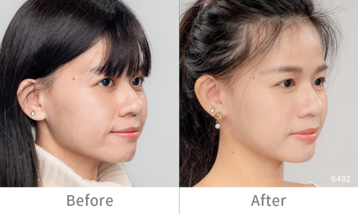 InMode鑽石超塑,InMode台灣叫什麼,InMode是什麼,InMode台灣價格,InMode