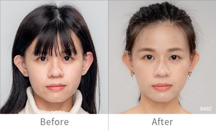 InMode鑽石超塑,InMode台灣叫什麼,InMode是什麼,InMode台灣價格,InMode