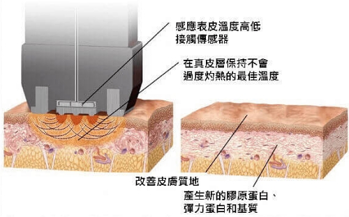 InMode鑽石超塑,InMode台灣叫什麼,InMode是什麼,InMode台灣價格,InMode