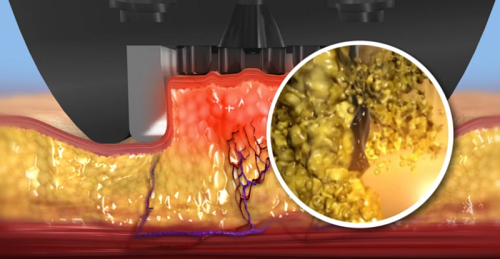 InMode鑽石超塑,InMode台灣叫什麼,InMode是什麼,InMode台灣價格,InMode