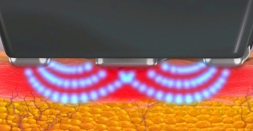 InMode鑽石超塑,InMode台灣叫什麼,InMode是什麼,InMode台灣價格,InMode