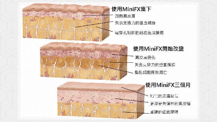 InMode鑽石超塑,InMode台灣叫什麼,InMode是什麼,InMode台灣價格,InMode