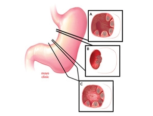 POSE 2.0胃鏡縫胃,POSE 2.0內視鏡減重,縮胃