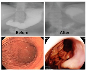 POSE 2.0胃鏡縫胃,POSE 2.0內視鏡減重,縮胃