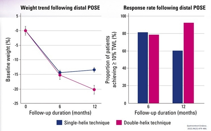 POSE 2.0胃鏡縫胃,POSE 2.0內視鏡減重,縮胃