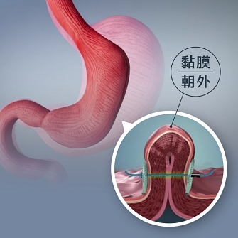 POSE 2.0胃鏡縫胃,POSE 2.0內視鏡減重,縮胃