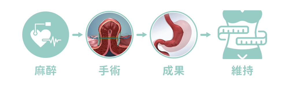 內視鏡雪靴夾胃摺疊術pose2.0手術流程與特色