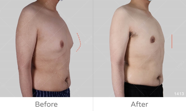 男性女乳症手術dcard,男性女乳症塑身衣要穿多久