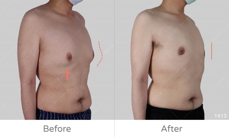 男性女乳症手術dcard,男性女乳症塑身衣要穿多久