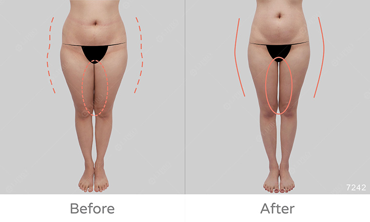 屁股兩側凹陷原因,屁股大怎麼消,麗波永康國際診所