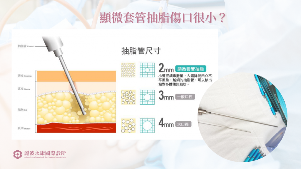 副乳手術線條雕塑說明